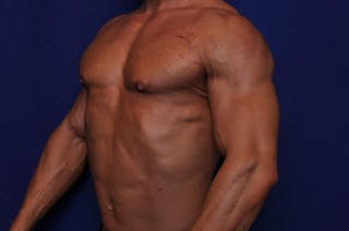 Bodybuilder Gynecomastia Before & After Gallery - Patient 291382 - Image 4