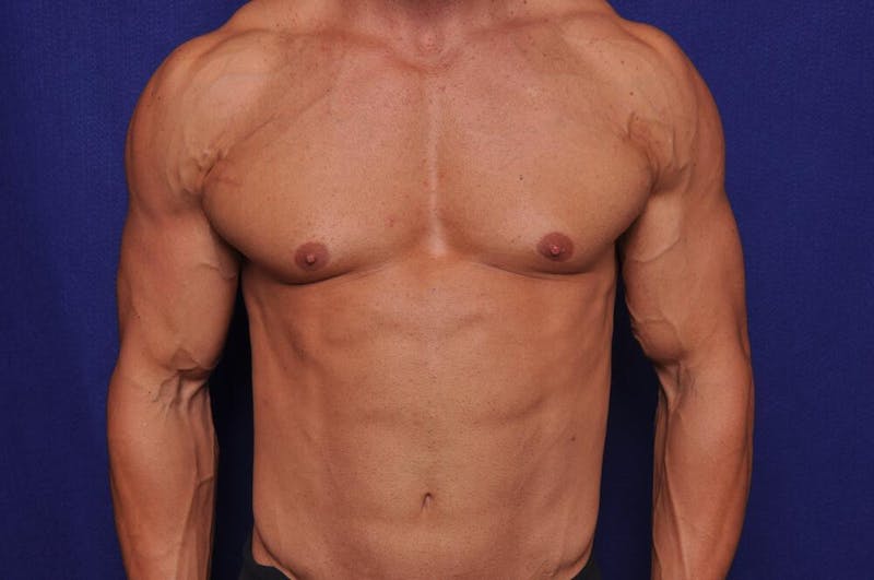 Bodybuilder Gynecomastia Before & After Gallery - Patient 291382 - Image 5