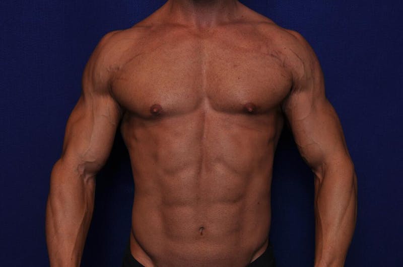 Bodybuilder Gynecomastia Before & After Gallery - Patient 291382 - Image 6