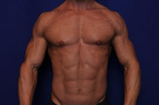 Bodybuilder Gynecomastia Before & After Gallery - Patient 291382 - Image 6