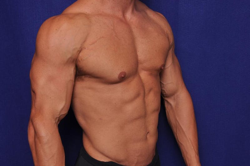 Bodybuilder Gynecomastia Before & After Gallery - Patient 291382 - Image 7