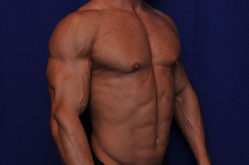Bodybuilder Gynecomastia Before & After Gallery - Patient 291382 - Image 8