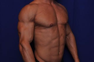 Bodybuilder Gynecomastia Before & After Gallery - Patient 291382 - Image 8