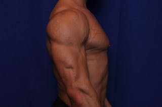 Bodybuilder Gynecomastia Before & After Gallery - Patient 291382 - Image 10