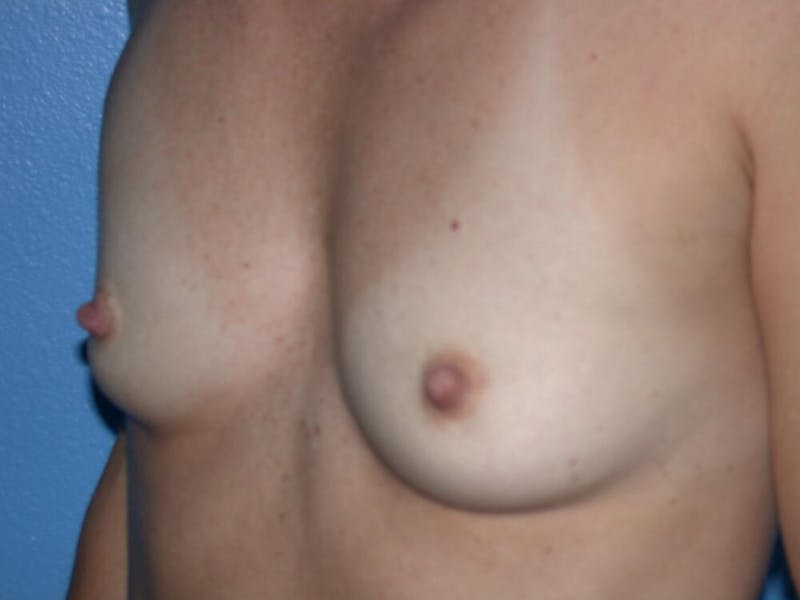 Breast Augmentation Before & After Gallery - Patient 720969 - Image 1