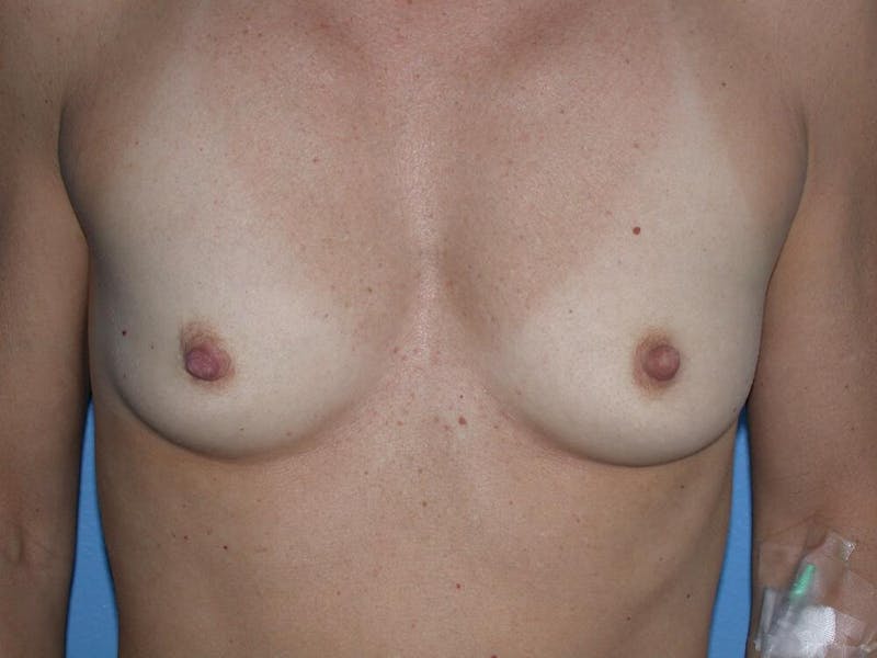 Breast Augmentation Before & After Gallery - Patient 720969 - Image 3