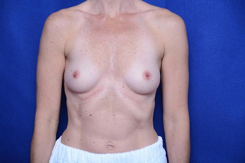 Breast Augmentation Before & After Gallery - Patient 222653 - Image 5