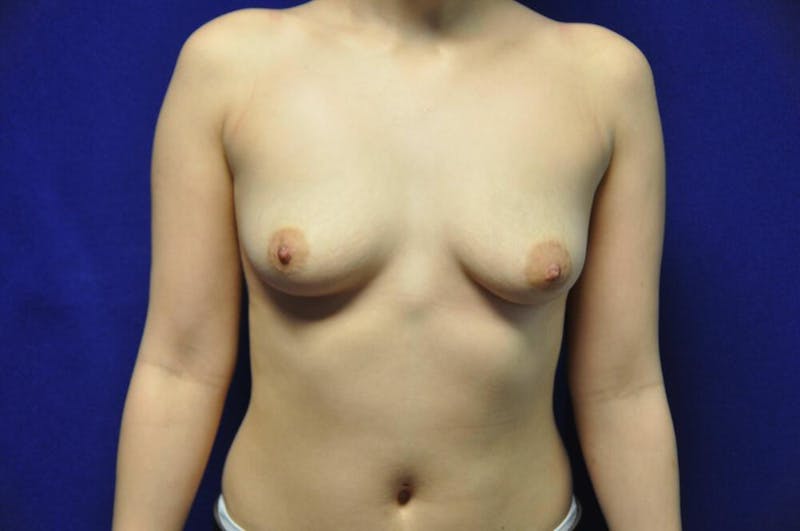 Breast Augmentation Before & After Gallery - Patient 112750 - Image 5