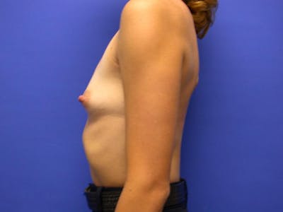 Breast Augmentation Before & After Gallery - Patient 305340 - Image 1