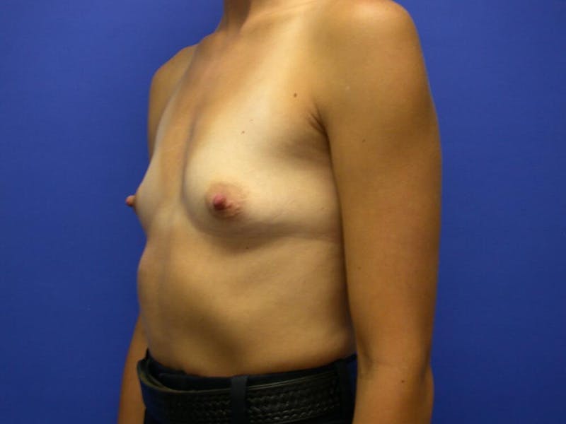 Breast Augmentation Before & After Gallery - Patient 305340 - Image 3