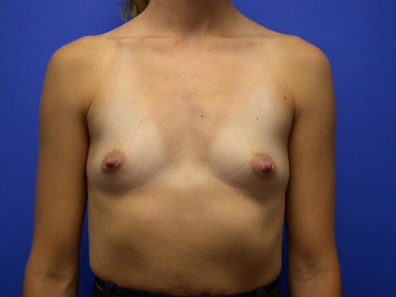 Breast Augmentation Before & After Gallery - Patient 305340 - Image 5