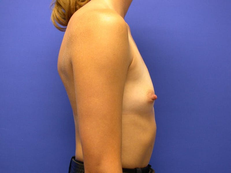 Breast Augmentation Before & After Gallery - Patient 305340 - Image 9