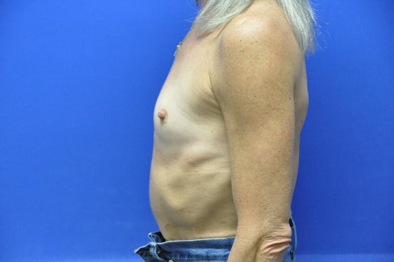 Breast Augmentation Before & After Gallery - Patient 377700 - Image 1
