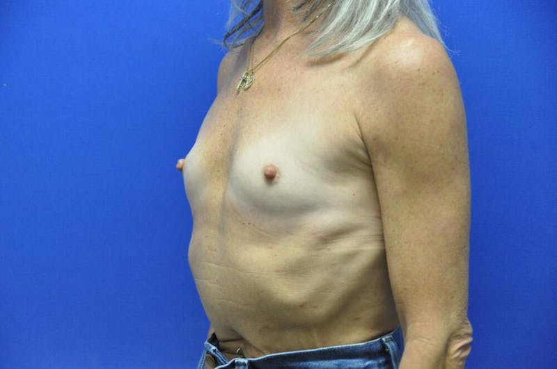 Breast Augmentation Before & After Gallery - Patient 377700 - Image 3