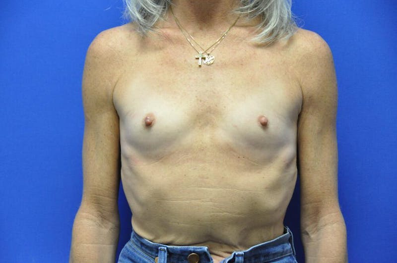 Breast Augmentation Before & After Gallery - Patient 377700 - Image 5