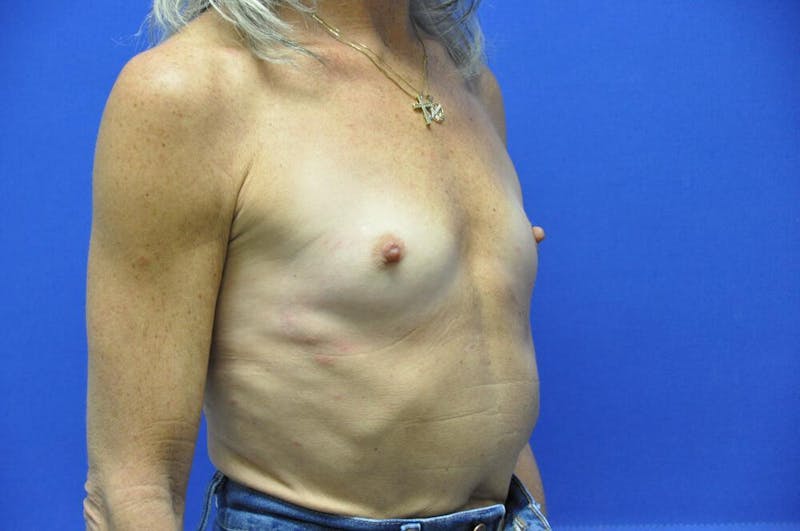 Breast Augmentation Before & After Gallery - Patient 377700 - Image 7