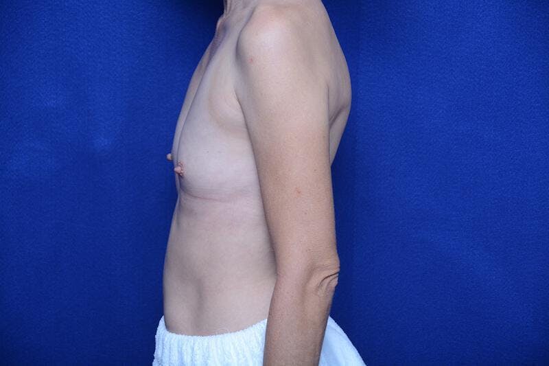Breast Augmentation Before & After Gallery - Patient 410758 - Image 1