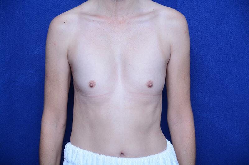 Breast Augmentation Before & After Gallery - Patient 410758 - Image 5