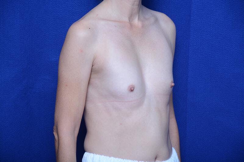 Breast Augmentation Before & After Gallery - Patient 410758 - Image 7