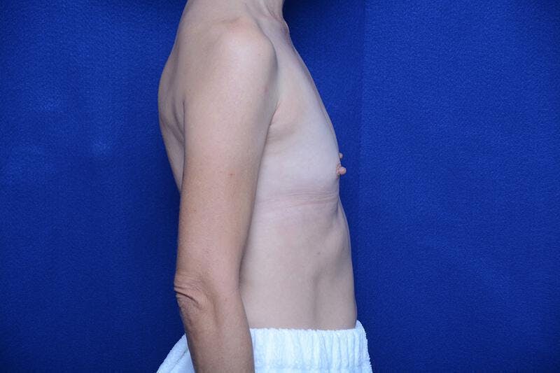 Breast Augmentation Before & After Gallery - Patient 410758 - Image 9