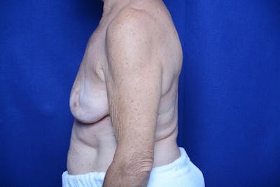 Breast Augmentation Before & After Gallery - Patient 208806 - Image 1