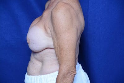 Breast Augmentation Before & After Gallery - Patient 208806 - Image 2