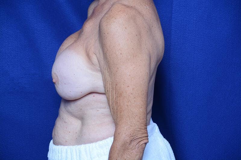 Breast Augmentation Before & After Gallery - Patient 208806 - Image 2