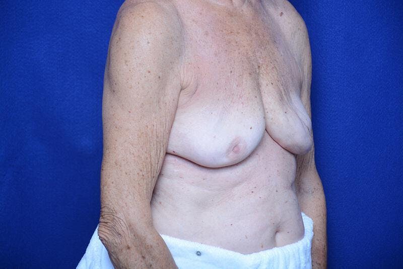 Breast Augmentation Before & After Gallery - Patient 208806 - Image 5