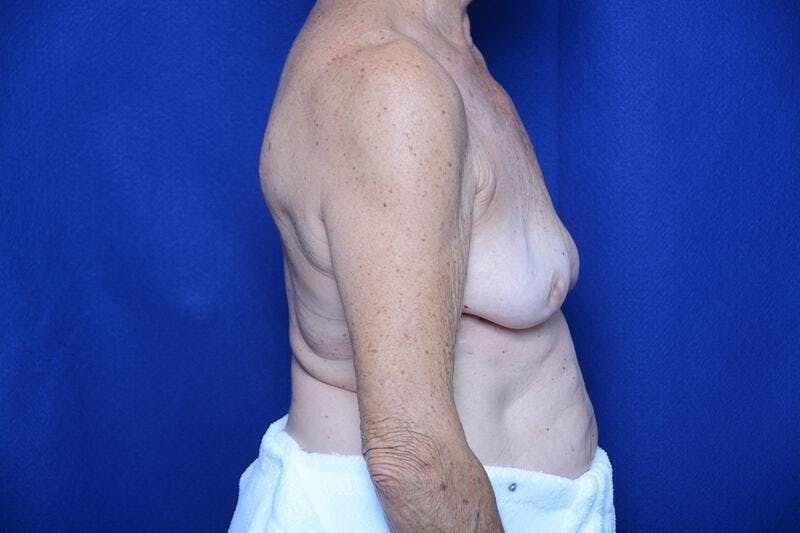 Breast Augmentation Before & After Gallery - Patient 208806 - Image 7