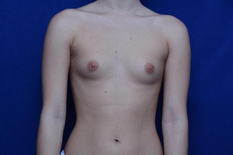 Breast Augmentation Before & After Gallery - Patient 118697 - Image 3