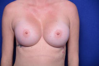 Breast Augmentation Before & After Gallery - Patient 367786 - Image 4