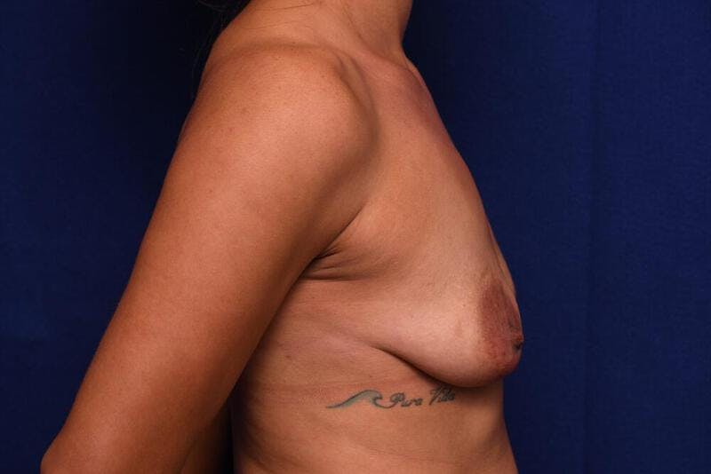 Breast Augmentation Before & After Gallery - Patient 299799 - Image 1