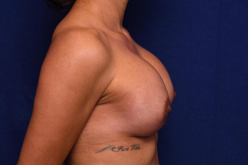 Breast Augmentation Before & After Gallery - Patient 299799 - Image 2