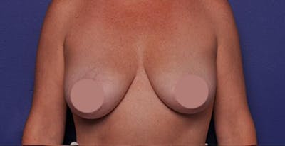 Breast Augmentation Before & After Gallery - Patient 667827 - Image 1