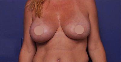 Breast Augmentation Before & After Gallery - Patient 667827 - Image 2