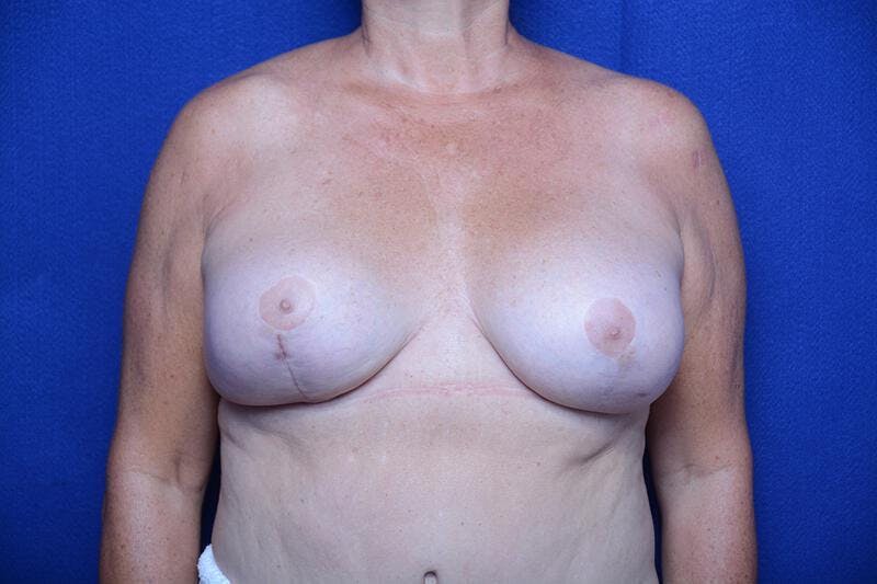 Breast Implant Removal Before & After Gallery - Patient 277810 - Image 1