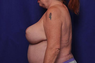 Breast Lift Before & After Gallery - Patient 410364 - Image 2