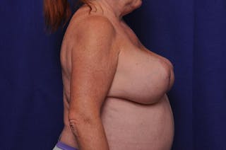 Breast Lift Before & After Gallery - Patient 410364 - Image 10