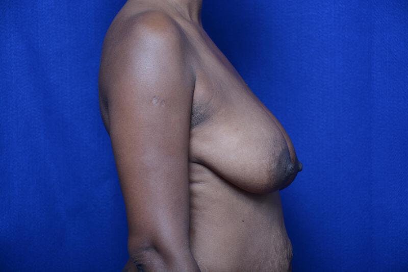 Breast Lift Before & After Gallery - Patient 257472 - Image 9
