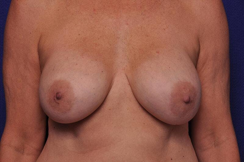 Breast Lift Before & After Gallery - Patient 111668 - Image 5