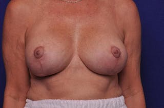 Breast Lift Before & After Gallery - Patient 111668 - Image 6