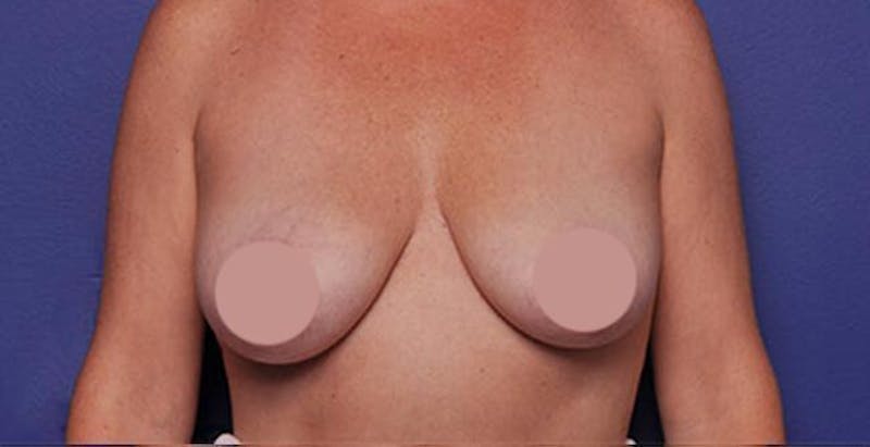 Breast Lift Before & After Gallery - Patient 214836 - Image 1