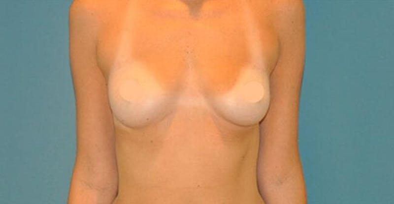 Breast Lift With Augmentation Before & After Gallery - Patient 226764 - Image 1