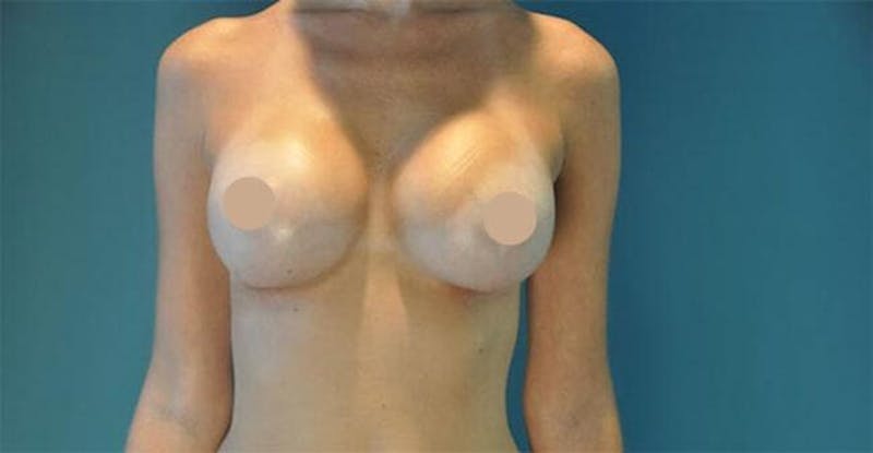 Breast Lift With Augmentation Before & After Gallery - Patient 226764 - Image 2