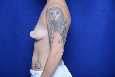 Breast Lift With Augmentation Before & After Gallery - Patient 206164 - Image 1