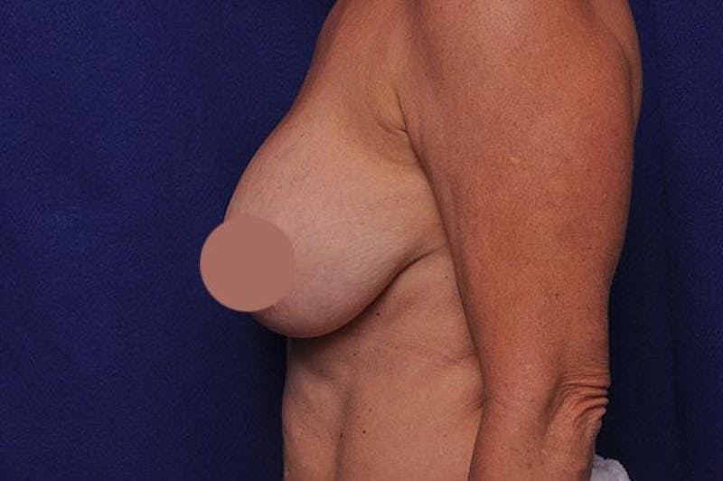 Breast Lift With Augmentation Before & After Gallery - Patient 398137 - Image 2