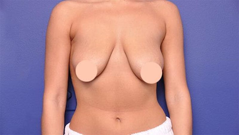 Breast Lift With Augmentation Before & After Gallery - Patient 340711 - Image 3
