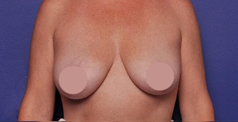 Breast Lift With Augmentation Before & After Gallery - Patient 710345 - Image 1
