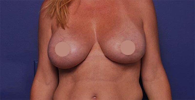Breast Lift With Augmentation Before & After Gallery - Patient 710345 - Image 2