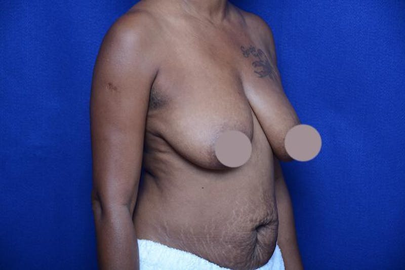 Breast Lift With Augmentation Before & After Gallery - Patient 104331 - Image 1